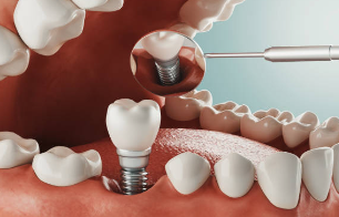 dental implants Melbourne